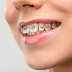 Orthodontic